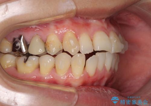 切端咬合をインビザライン矯正で解消の治療中