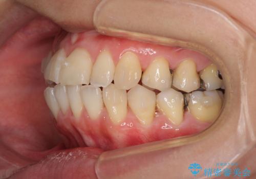 切端咬合をインビザライン矯正で解消の治療中