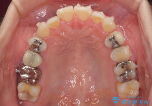 切端咬合をインビザライン矯正で解消の治療中