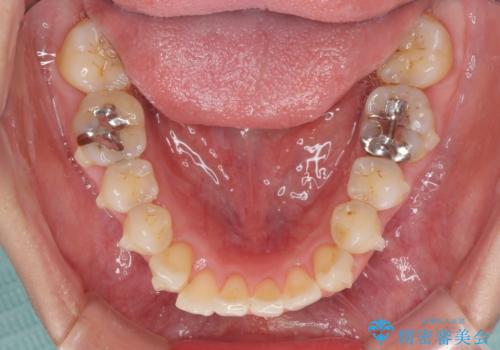 切端咬合をインビザライン矯正で解消の治療中
