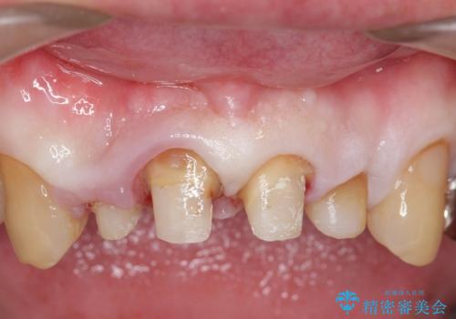オールセラミッククラウン セラミックで前歯の見た目を改善の治療前