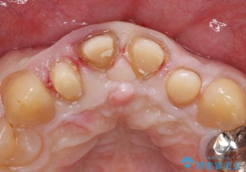 オールセラミッククラウン セラミックで前歯の見た目を改善の治療前