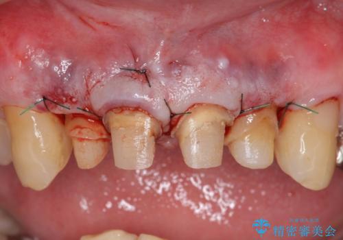 オールセラミッククラウン セラミックで前歯の見た目を改善の治療後