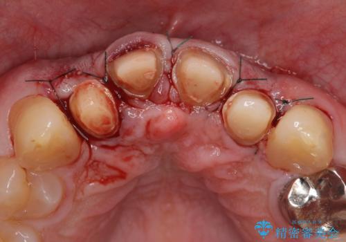 オールセラミッククラウン セラミックで前歯の見た目を改善の治療後
