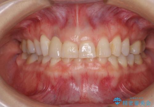 歯肉が腫れている前歯　外科処置を併用したオールセラミッククラウンの治療後