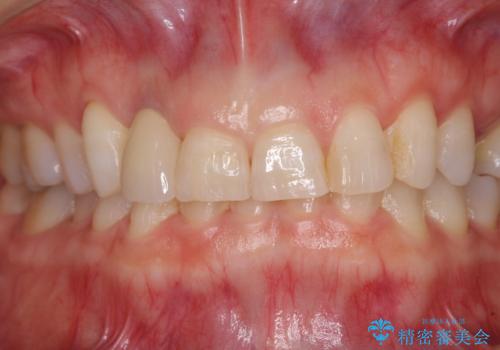 歯肉が腫れている前歯 外科処置を併用したオールセラミッククラウンの治療後