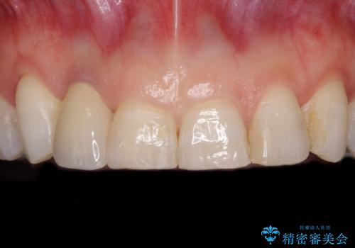 歯肉が腫れている前歯 外科処置を併用したオールセラミッククラウンの治療後