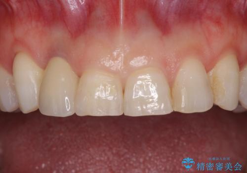 歯肉が腫れている前歯 外科処置を併用したオールセラミッククラウンの治療後