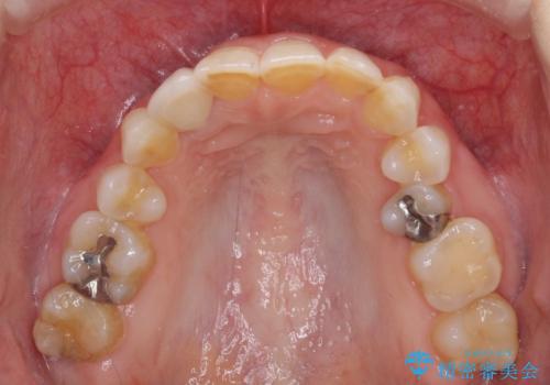 歯肉が腫れている前歯 外科処置を併用したオールセラミッククラウンの治療後