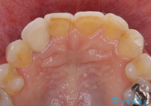 歯肉が腫れている前歯 外科処置を併用したオールセラミッククラウンの治療後