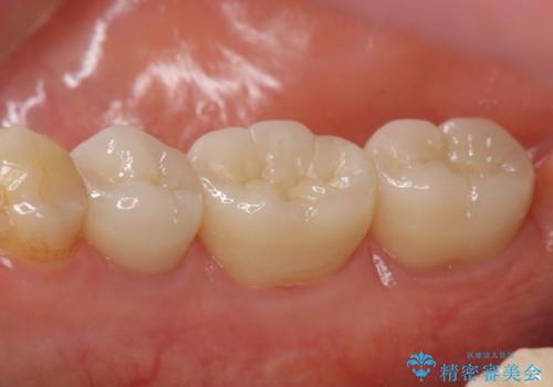 オールセラミッククラウン 神経が死んでいる歯の治療の治療後