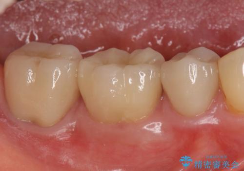 オールセラミッククラウン 神経が死んでいる歯の治療の治療後
