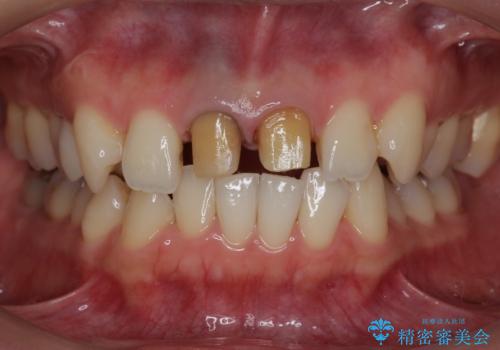 神経をとった前歯が変色してきたの治療中