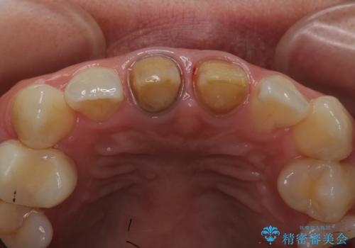 神経をとった前歯が変色してきたの治療中