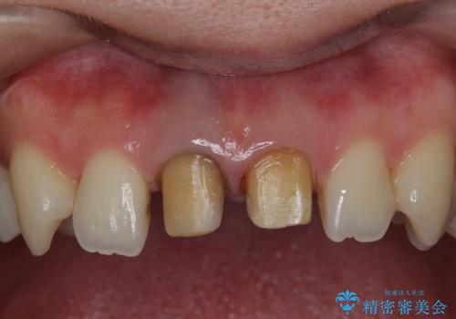 神経をとった前歯が変色してきたの治療中