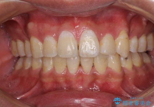 前歯の叢生を解消　ワイヤー装置での抜歯矯正の症例 治療後