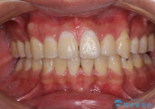 前歯の叢生を解消　ワイヤー装置での抜歯矯正の治療後