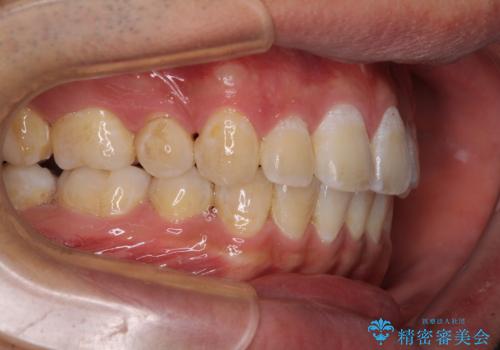 前歯の叢生を解消　ワイヤー装置での抜歯矯正の治療後