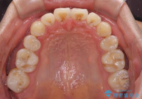 前歯の叢生を解消　ワイヤー装置での抜歯矯正の治療後