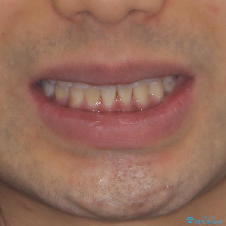 前歯の叢生を解消　ワイヤー装置での抜歯矯正の治療後（顔貌）