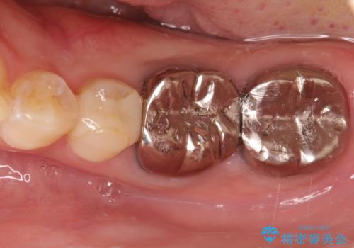 【メタルフリー】オールセラミッククラウンの治療前