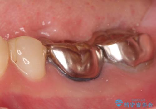 【メタルフリー】オールセラミッククラウンの治療前