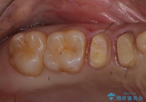 他院の根の治療で一向に治らない、さらに歯根を切ってもらったが良くならないの治療中