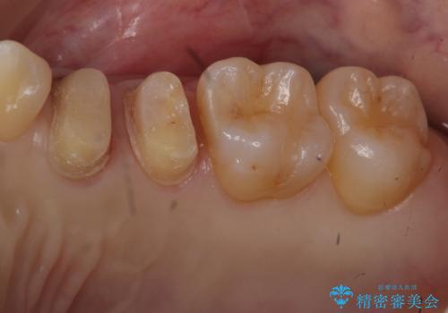 他院の根の治療で一向に治らない、さらに歯根を切ってもらったが良くならないの治療中