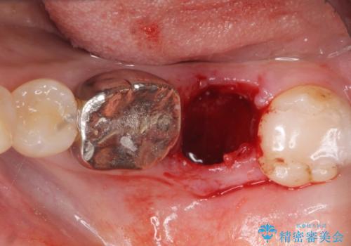 インプラントは嫌 親知らずの移植 50代女性の治療中