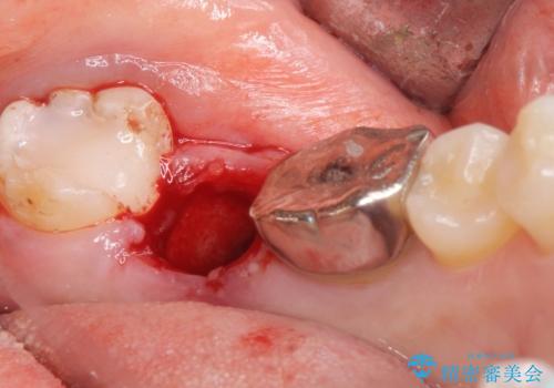 インプラントは嫌 親知らずの移植 50代女性の治療中