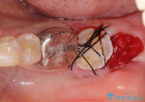 インプラントは嫌 親知らずの移植 50代女性の治療中