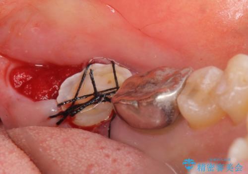 インプラントは嫌 親知らずの移植 50代女性の治療中