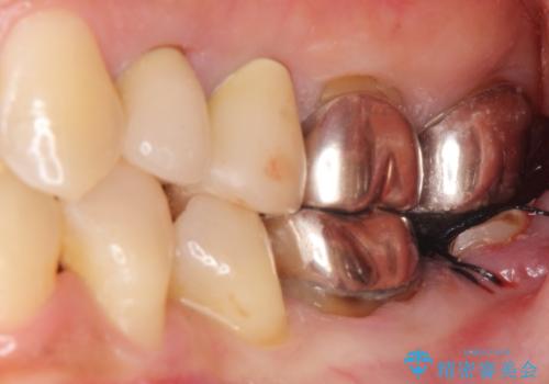 インプラントは嫌 親知らずの移植 50代女性の治療中