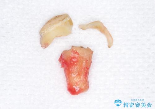 インプラントは嫌 親知らずの移植 50代女性の治療前