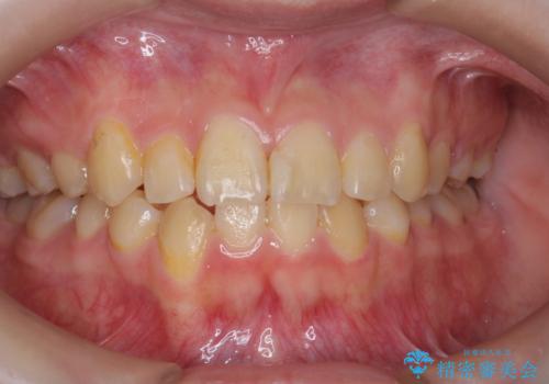 ホワイトニングで歯を白くして、口元を明るく爽やかに!の症例 治療前