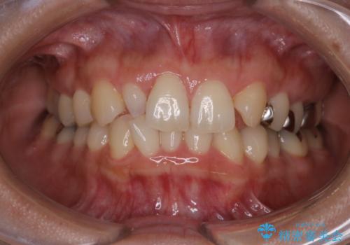 笑うとキラリと光る銀歯を何とかしたい:適合の良いセラミックで長持ちする歯にの症例 治療前