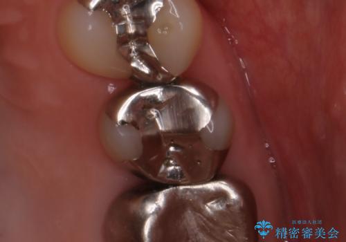 笑うとキラリと光る銀歯を何とかしたい:適合の良いセラミックで長持ちする歯にの治療前