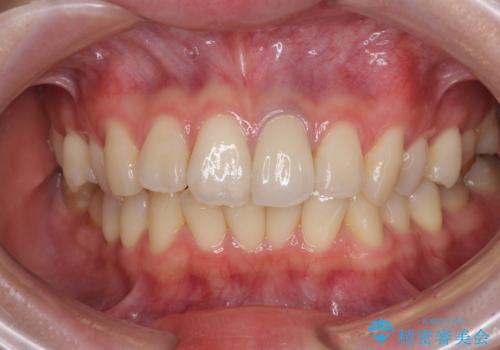 境目が見えている前歯のクラウンをオールセラミッククラウンにの治療後