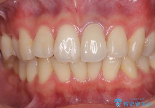 境目が見えている前歯のクラウンをオールセラミッククラウンにの治療後