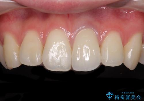 境目が見えている前歯のクラウンをオールセラミッククラウンにの治療後