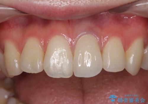 境目が見えている前歯のクラウンをオールセラミッククラウンにの治療後