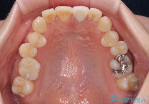 境目が見えている前歯のクラウンをオールセラミッククラウンにの治療後