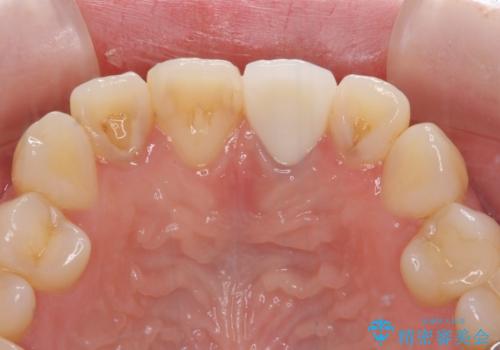 境目が見えている前歯のクラウンをオールセラミッククラウンにの治療後