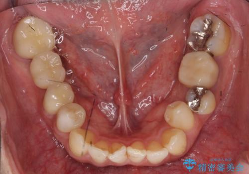 虫歯がひどく抜歯 奥歯をブリッジにの治療後