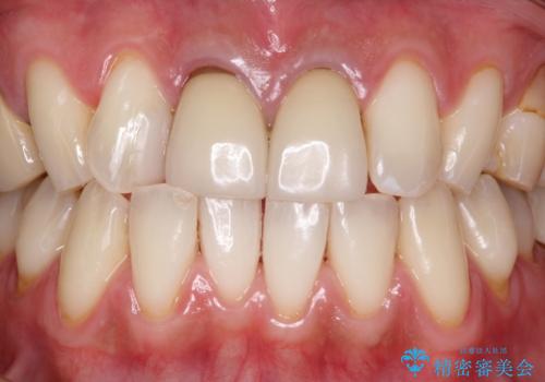 インビザラインでの矯正前にPMTCの治療後