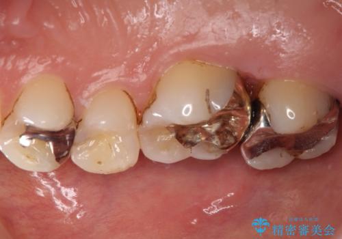 銀歯が外れてしまった ゴールドインレーによる補綴治療