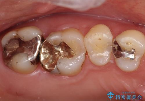 銀歯が外れてしまった　ゴールドインレーによる補綴治療の治療後