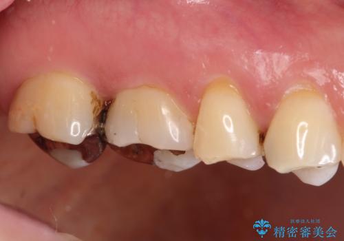 銀歯が外れてしまった ゴールドインレーによる補綴治療の治療後