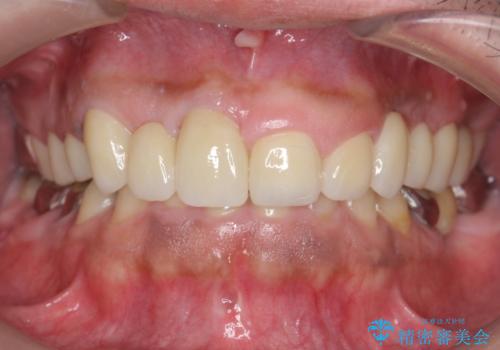 オールセラミッククラウン ブリッジによる欠損歯の補綴の治療後