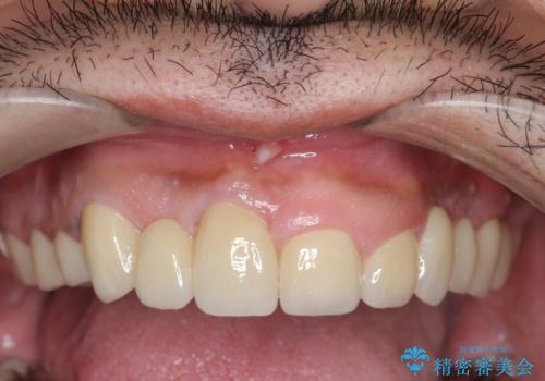 オールセラミッククラウン　ブリッジによる欠損歯の補綴の治療後